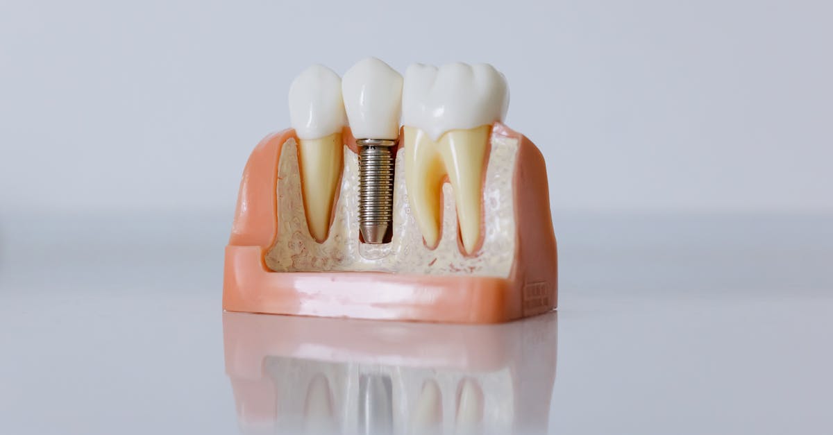 découvrez tout ce que vous devez savoir sur l’implant dentaire : avantages, procédure, durée de vie et conseils pour réussir votre traitement d’implantologie. consultez notre guide complet !